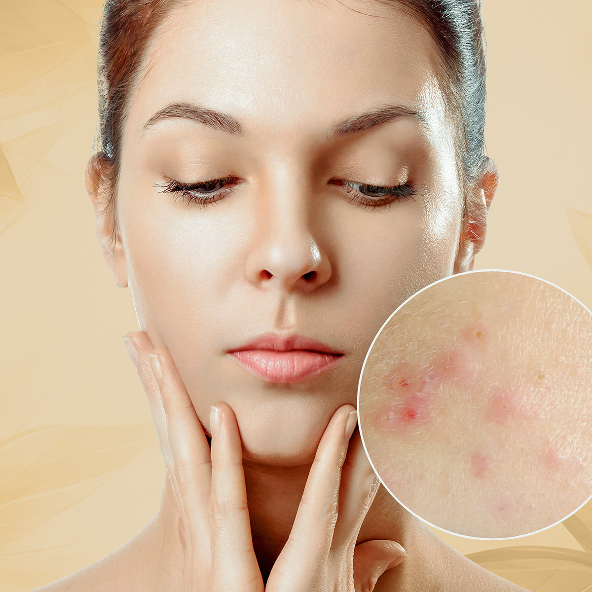 Acne / Pimple