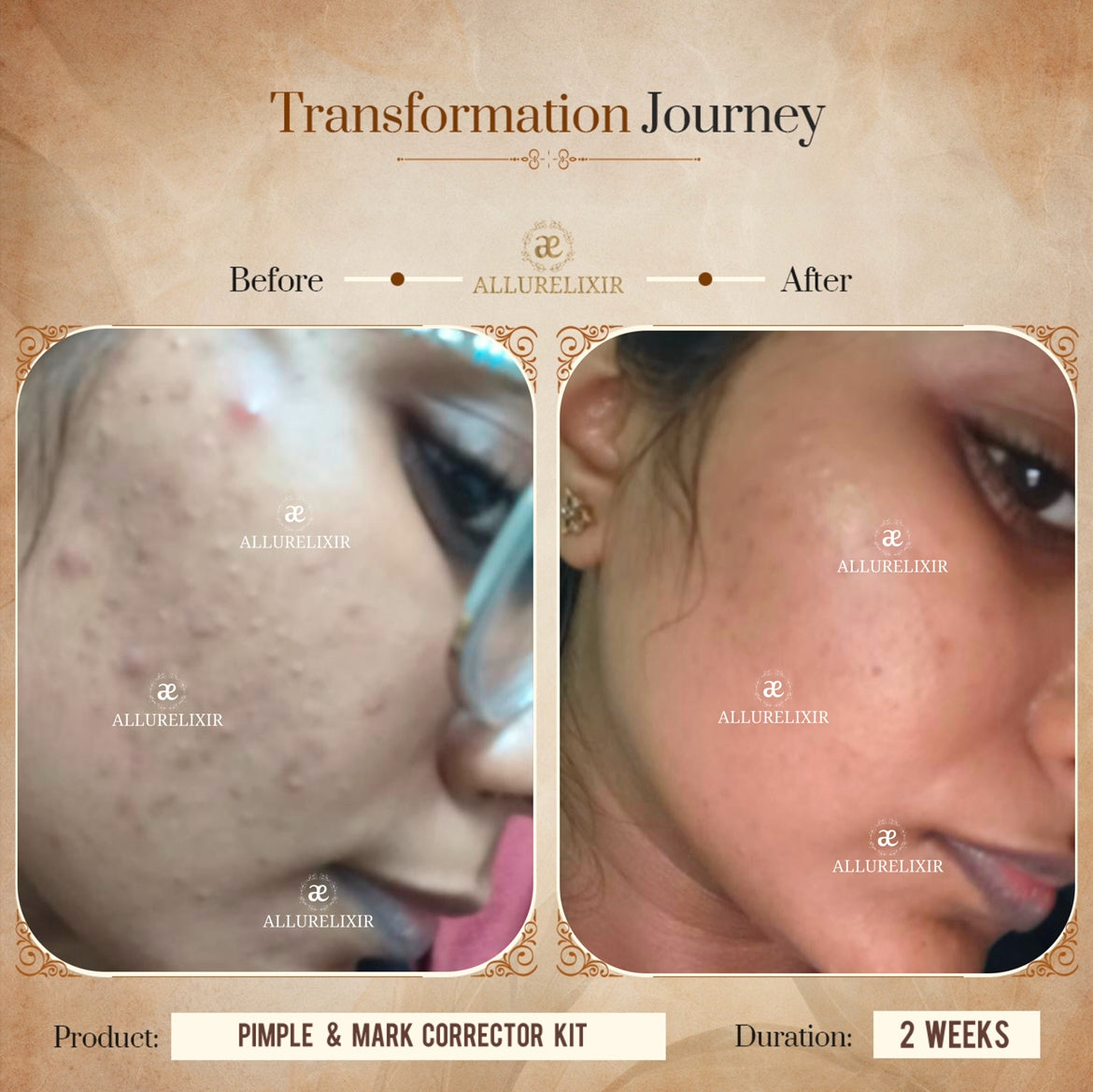 Pimple & Marks Corrector Kit (Tulsnah Pack + Varnyah Pack + Ardhrah gel )