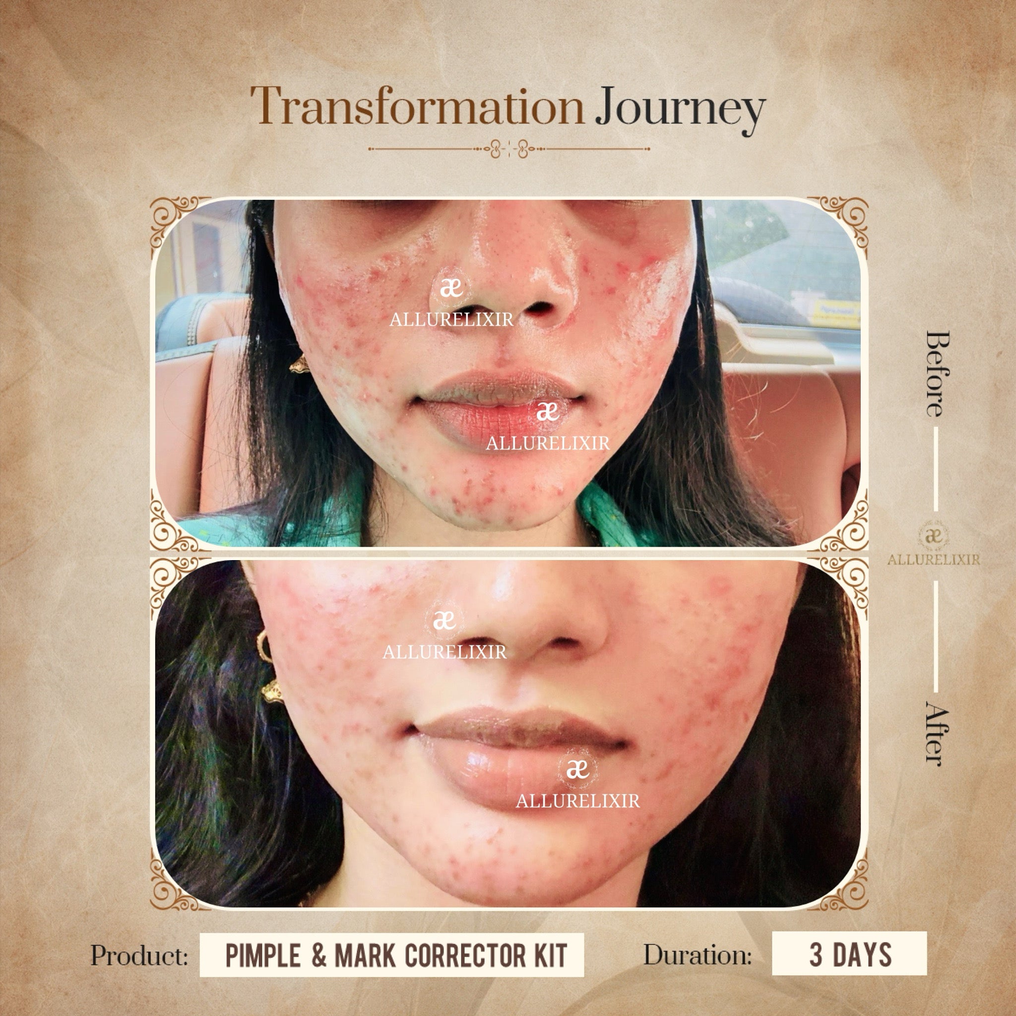 Pimple & Marks Corrector Kit (Tulsnah Pack + Varnyah Pack + Ardhrah gel )