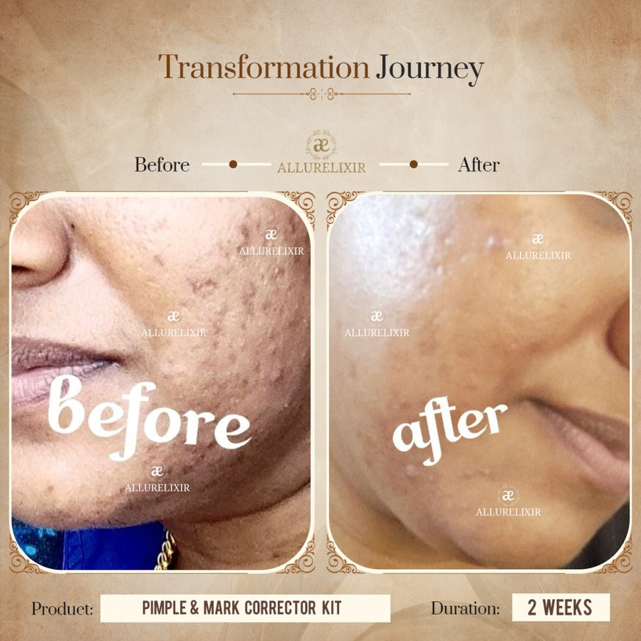 Pimple & Marks Corrector Kit (Tulsnah Pack + Varnyah Pack + Ardhrah gel )