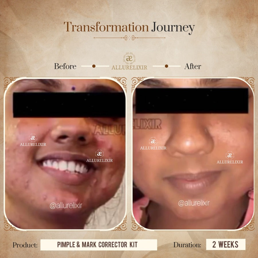 Pimple & Marks Corrector Kit (Tulsnah Pack + Varnyah Pack + Ardhrah gel )