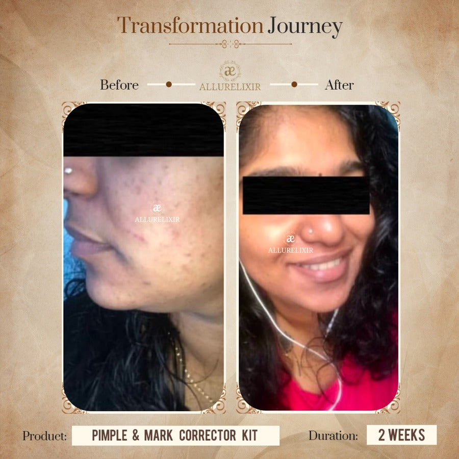 Pimple & Marks Corrector Kit (Tulsnah Pack + Varnyah Pack + Ardhrah gel )