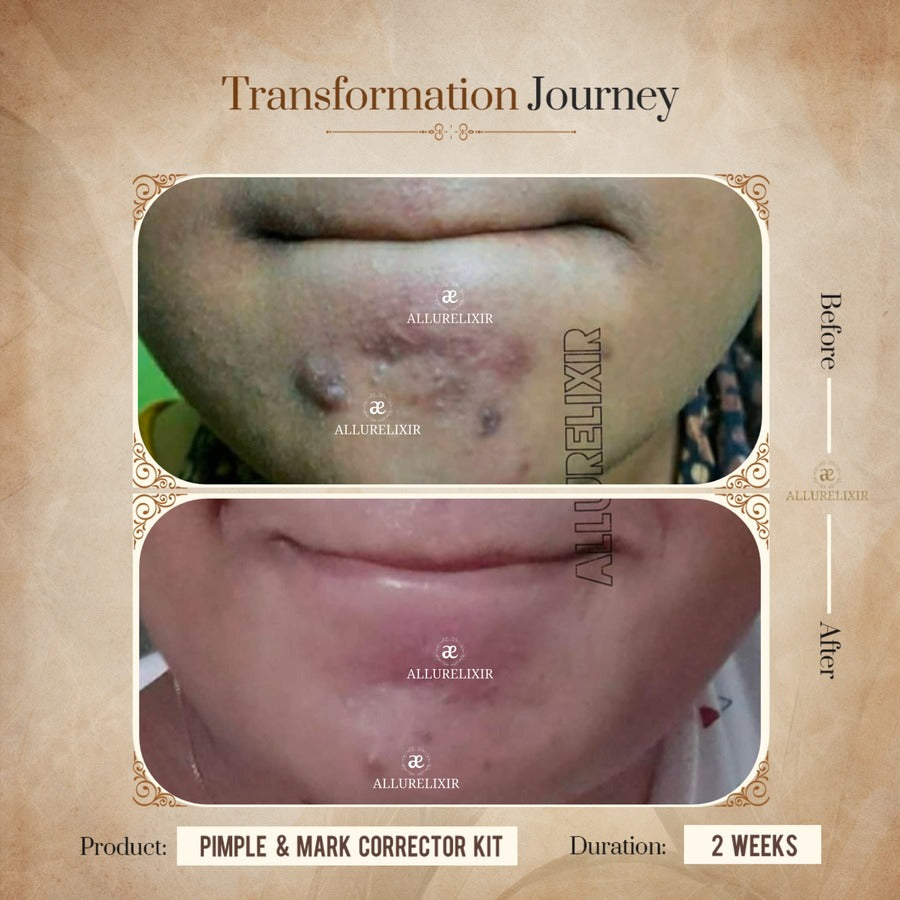 Pimple & Marks Corrector Kit (Tulsnah Pack + Varnyah Pack + Ardhrah gel )