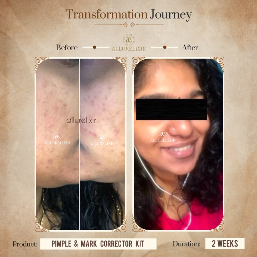 Pimple & Marks Corrector Kit (Tulsnah Pack + Varnyah Pack + Ardhrah gel )