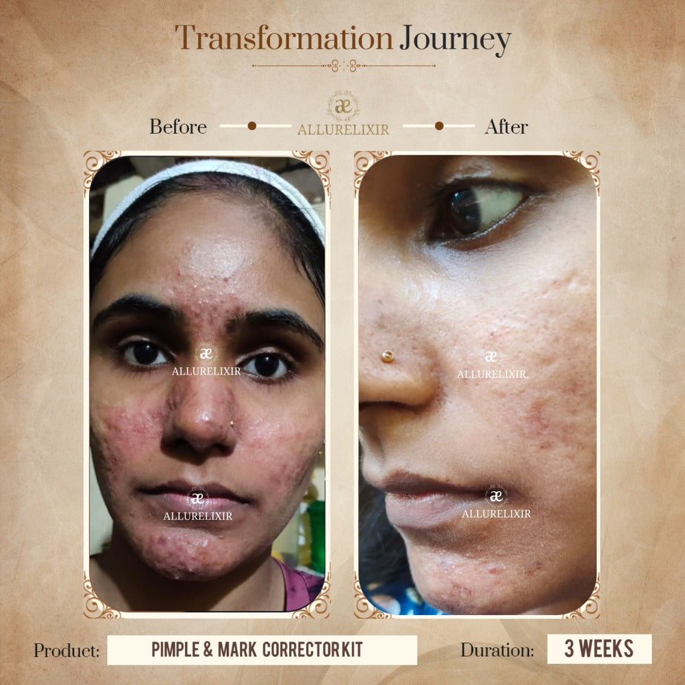 Pimple & Marks Corrector Kit (Tulsnah Pack + Varnyah Pack + Ardhrah gel )