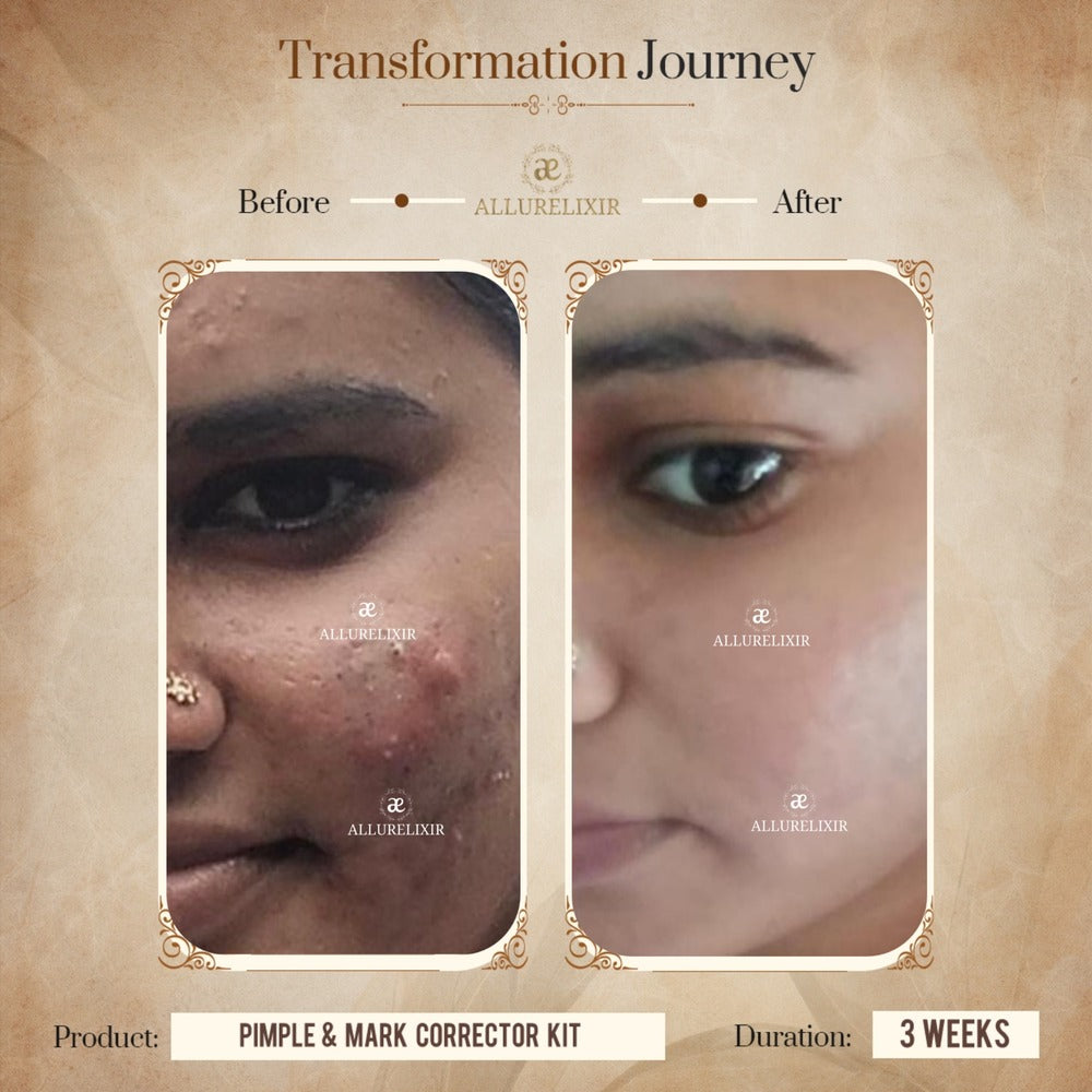 Pimple & Marks Corrector Kit (Tulsnah Pack + Varnyah Pack + Ardhrah gel )
