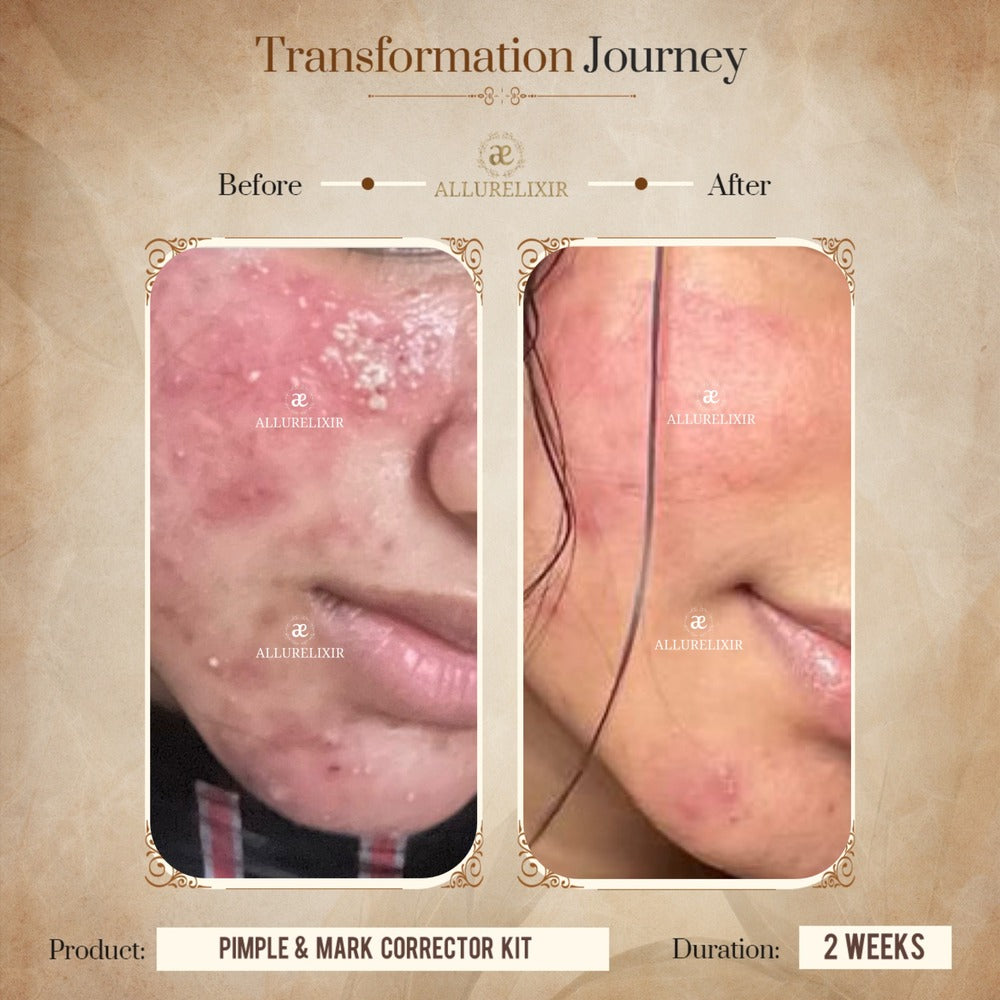 Pimple & Marks Corrector Kit (Tulsnah Pack + Varnyah Pack + Ardhrah gel )