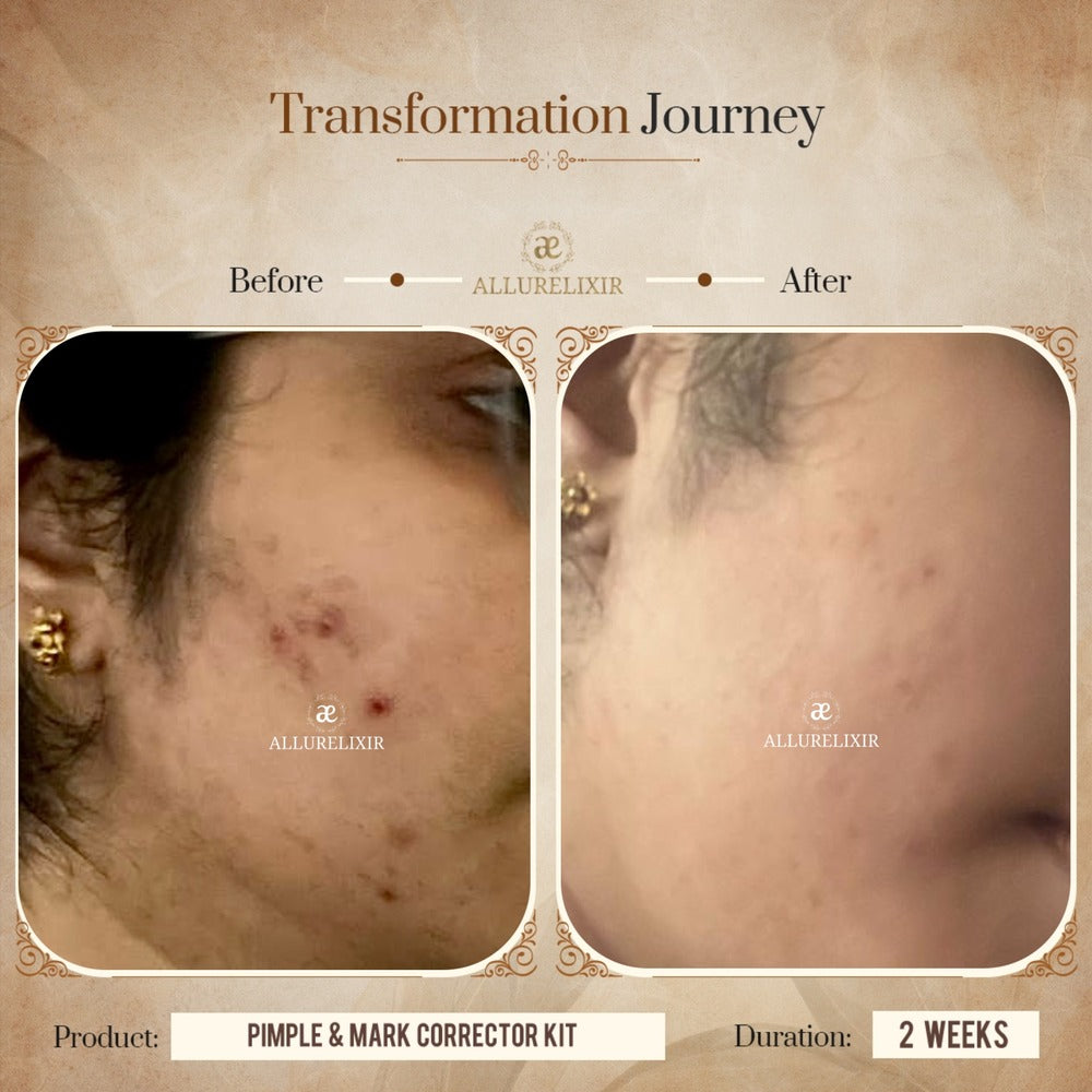 Pimple & Marks Corrector Kit (Tulsnah Pack + Varnyah Pack + Ardhrah gel )