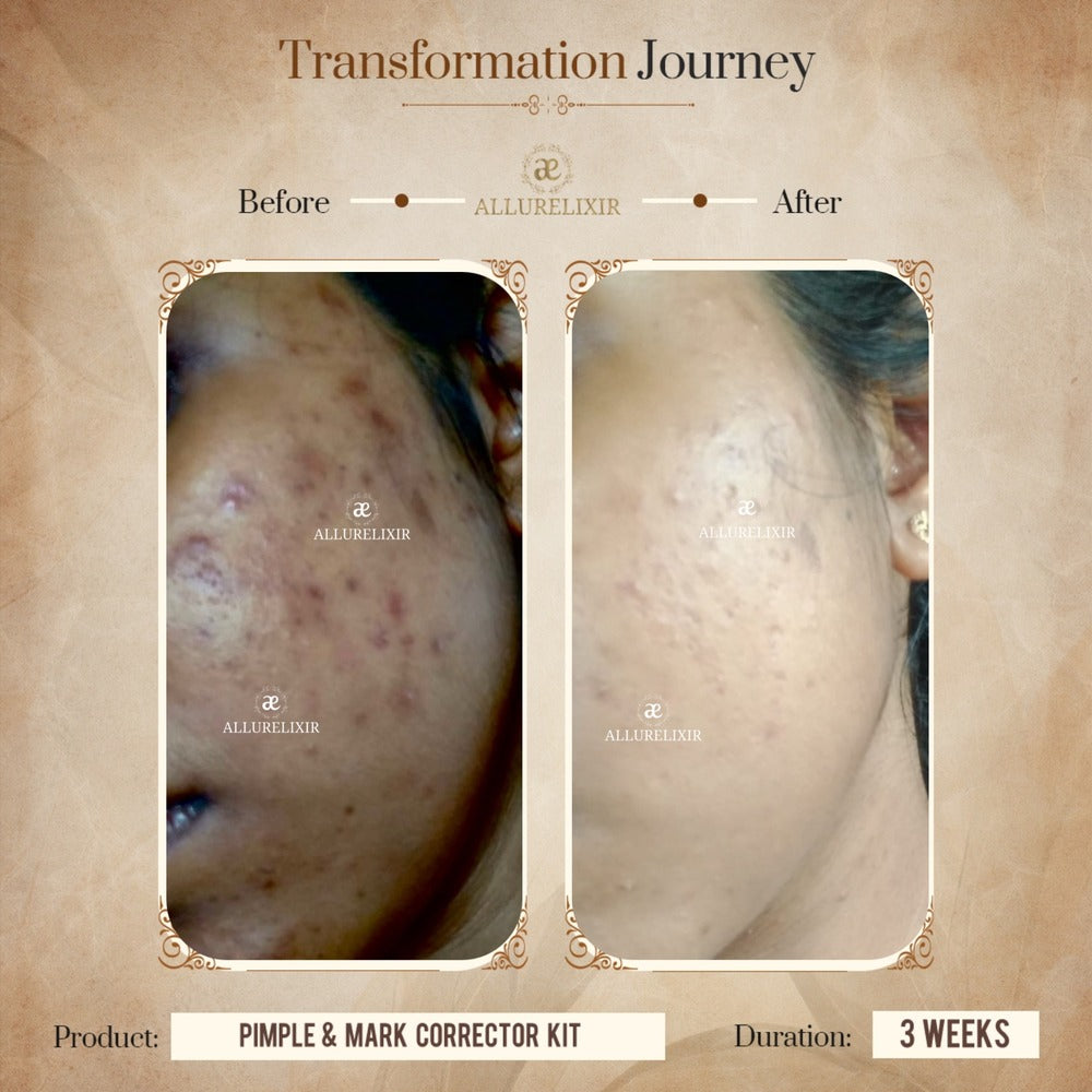 Pimple & Marks Corrector Kit (Tulsnah Pack + Varnyah Pack + Ardhrah gel )