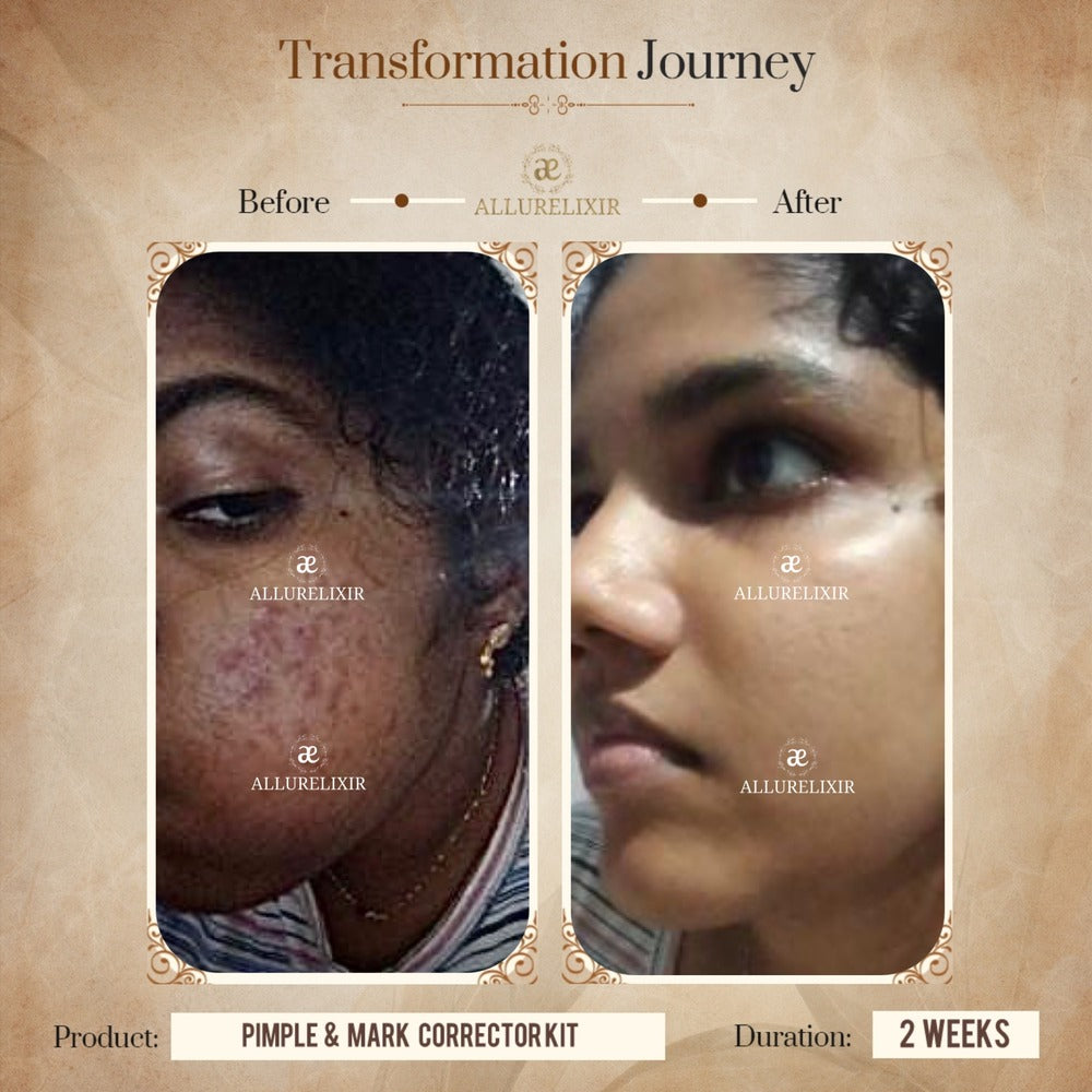 Pimple & Marks Corrector Kit (Tulsnah Pack + Varnyah Pack + Ardhrah gel )
