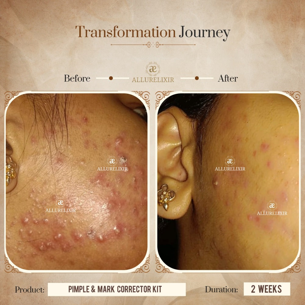 Pimple & Marks Corrector Kit (Tulsnah Pack + Varnyah Pack + Ardhrah gel )