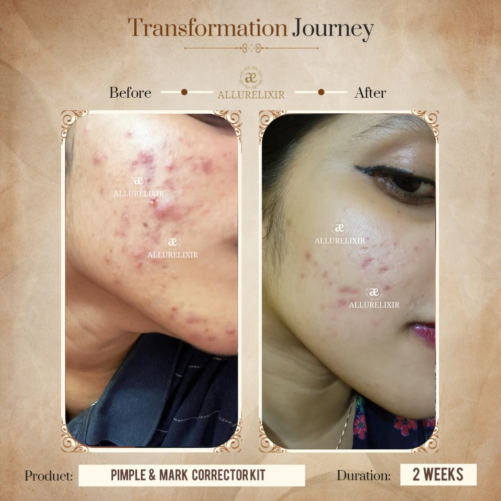 Pimple & Marks Corrector Kit (Tulsnah Pack + Varnyah Pack + Ardhrah gel )
