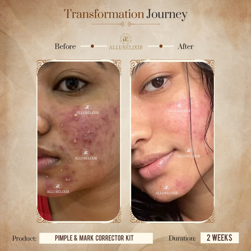 Pimple & Marks Corrector Kit (Tulsnah Pack + Varnyah Pack + Ardhrah gel )