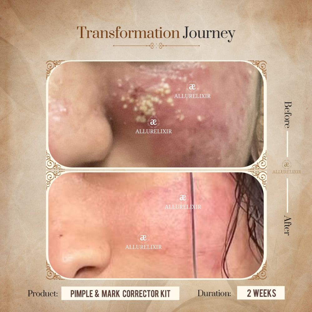 Pimple & Marks Corrector Kit (Tulsnah Pack + Varnyah Pack + Ardhrah gel )