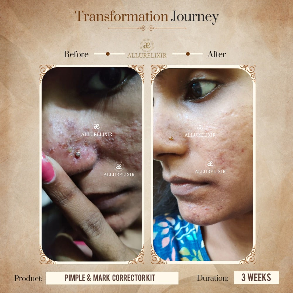 Pimple & Marks Corrector Kit (Tulsnah Pack + Varnyah Pack + Ardhrah gel )