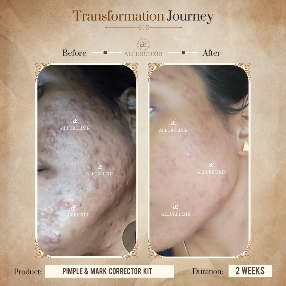 Pimple & Marks Corrector Kit (Tulsnah Pack + Varnyah Pack + Ardhrah gel )