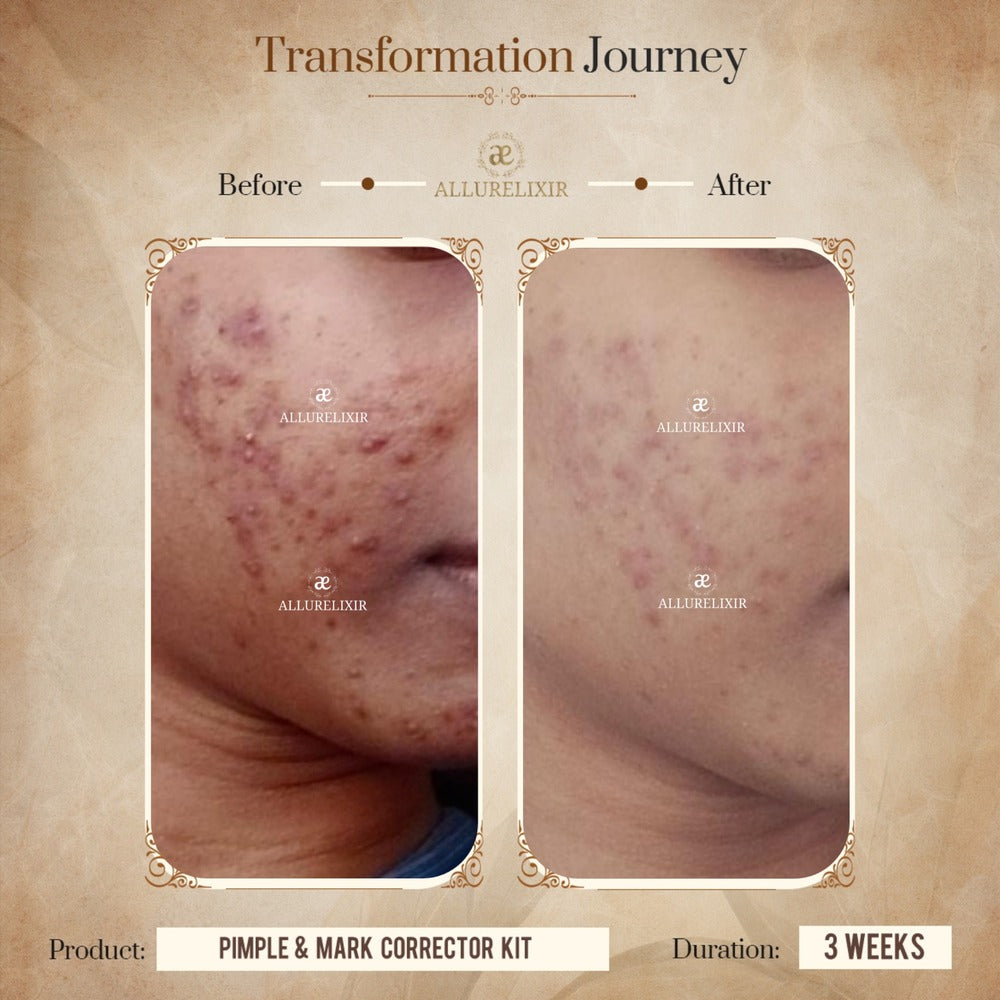 Pimple & Marks Corrector Kit (Tulsnah Pack + Varnyah Pack + Ardhrah gel )