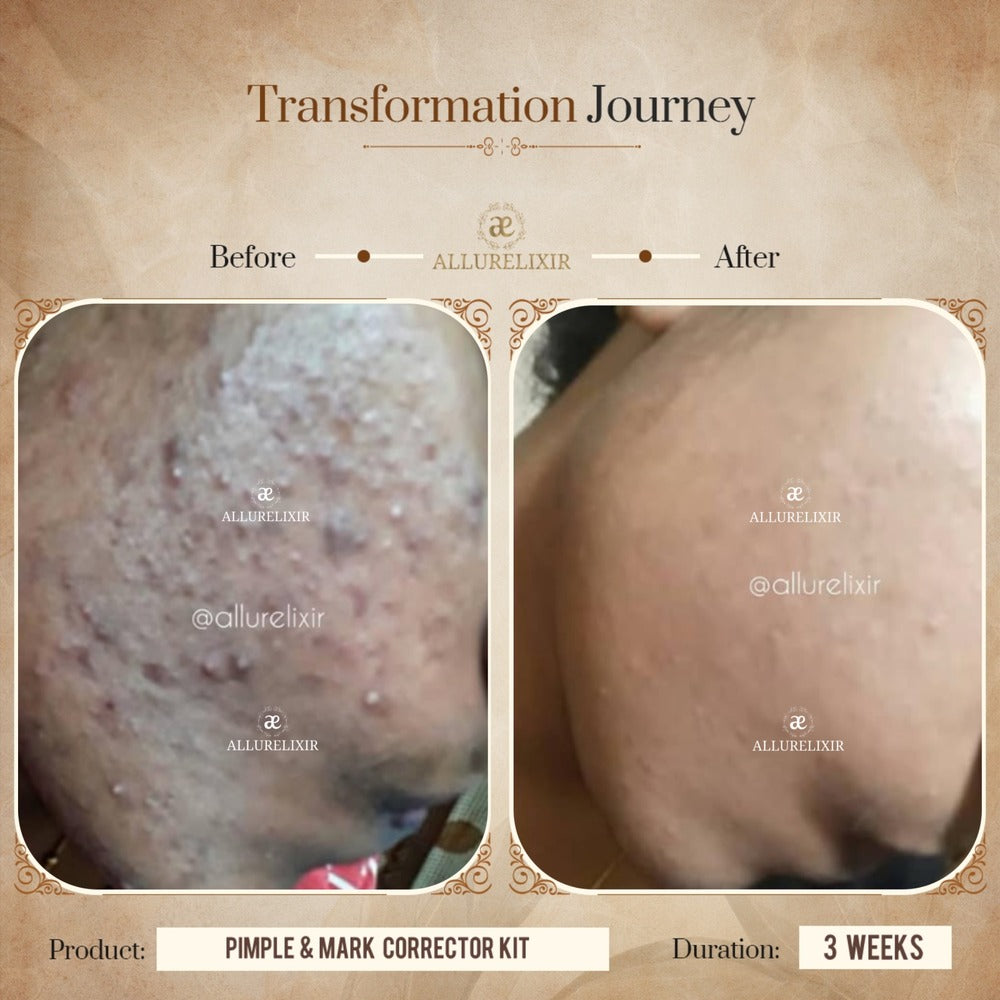 Pimple & Marks Corrector Kit (Tulsnah Pack + Varnyah Pack + Ardhrah gel )