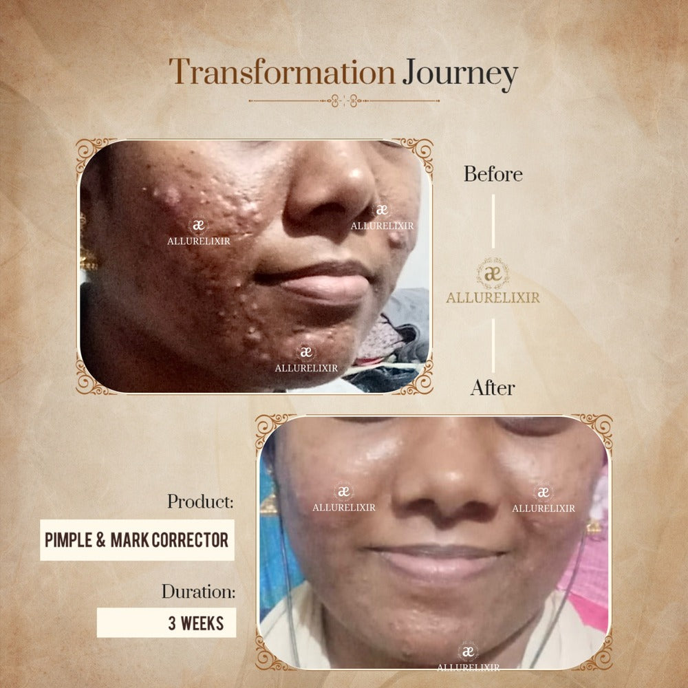 Pimple & Marks Corrector Kit (Tulsnah Pack + Varnyah Pack + Ardhrah gel )