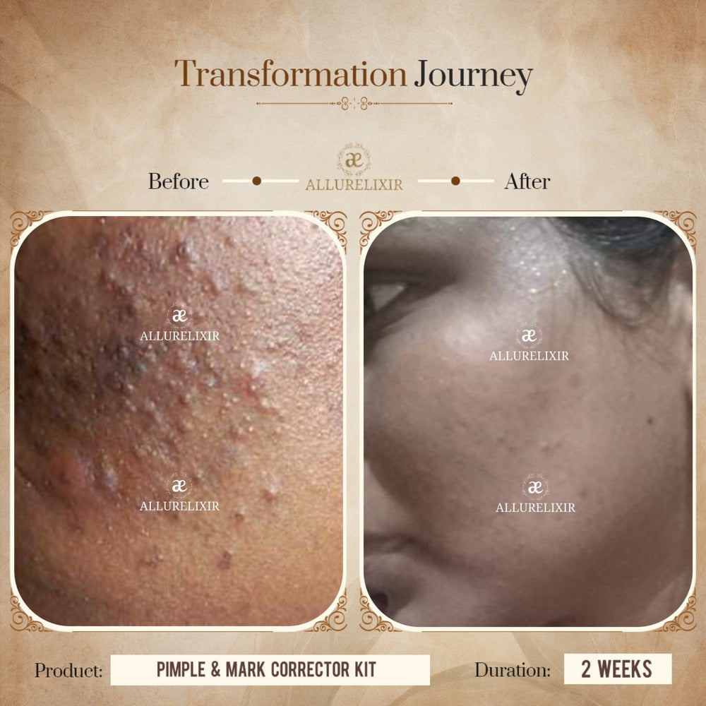 Pimple & Marks Corrector Kit (Tulsnah Pack + Varnyah Pack + Ardhrah gel )
