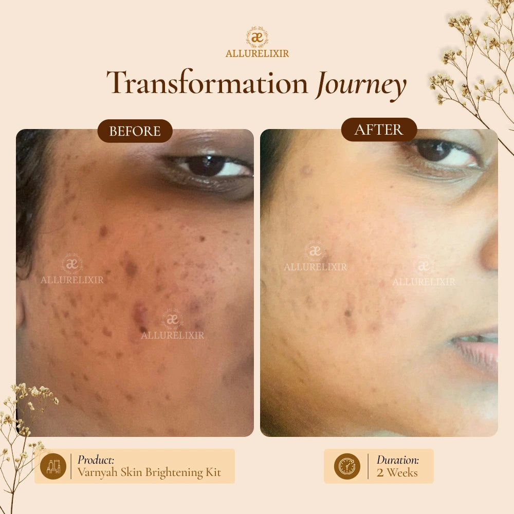 Pimple Skin Brightening Kit ( Tulsnah Pack + Varnyah Pack + Lip balm + Body Lotion )