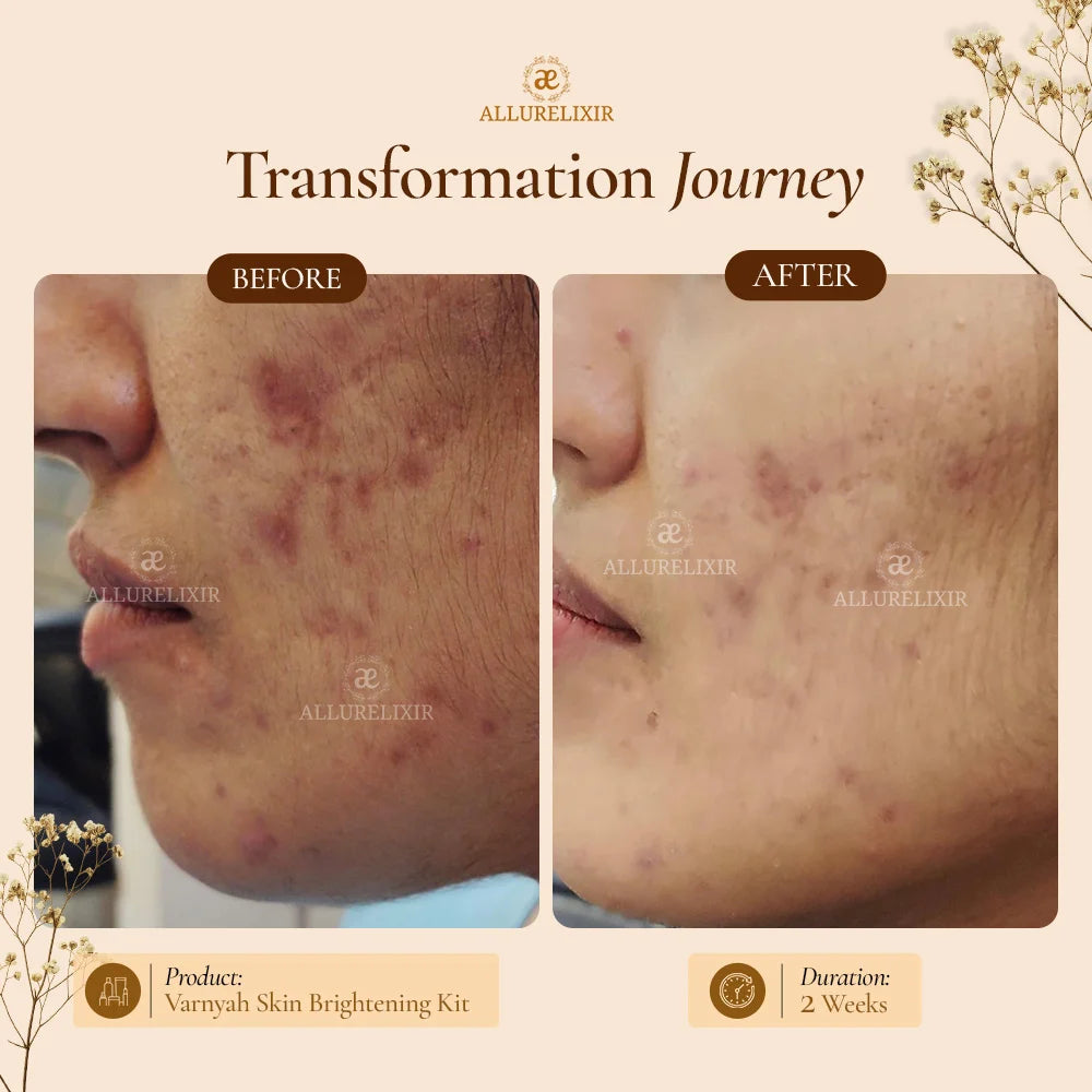 Pimple Skin Brightening Kit ( Tulsnah Pack + Varnyah Pack + Lip balm + Body Lotion )