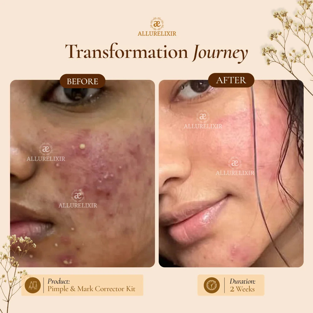Pimple Skin Mega Brightening Kit ( Tulsnah Pack + Varnyah Pack + Lip Balm + Body Oil + Body Lotion )