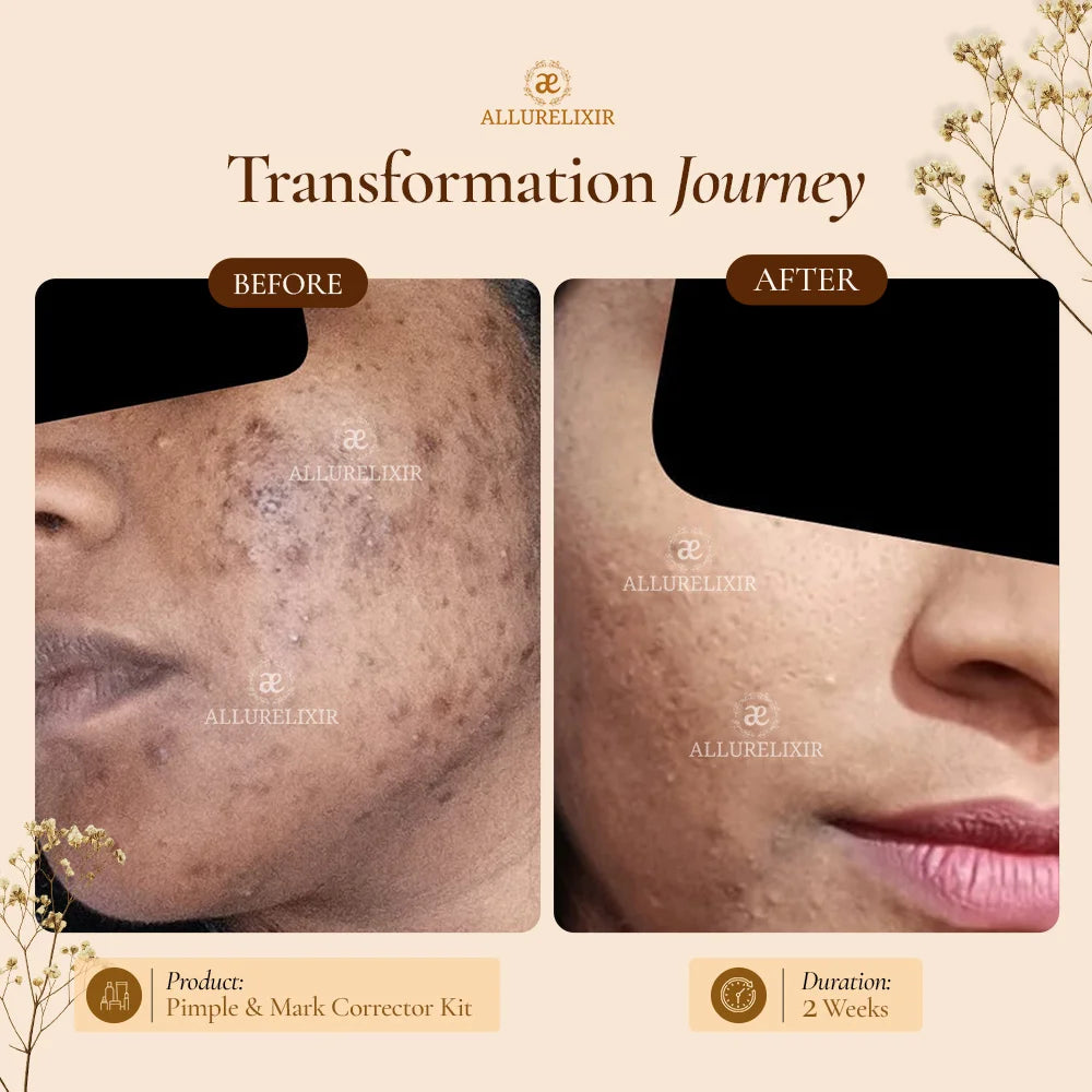 Mega Pimple & Mark Corrector kit (Tulsnah Pack + Varnyah Pack + Ardhrah Gel + Face cleanser)