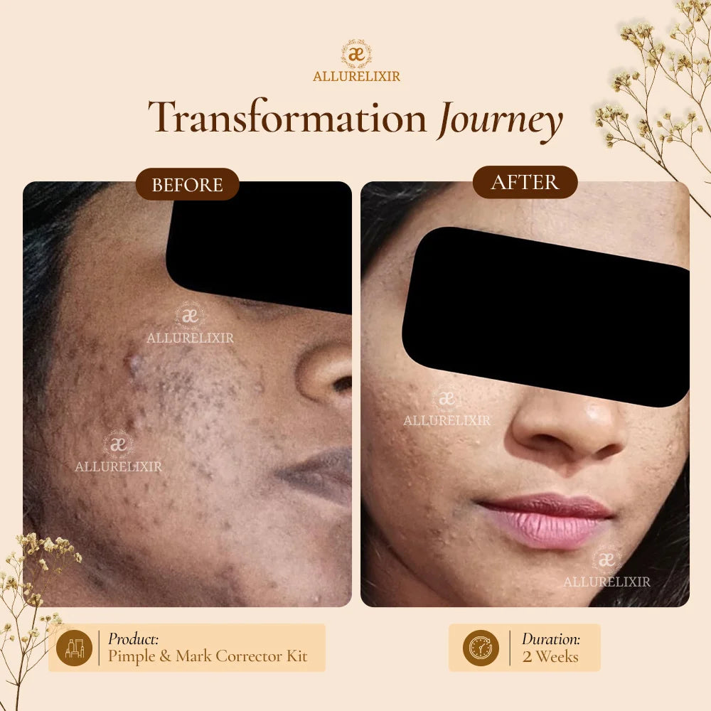 Mega Pimple & Mark Corrector kit (Tulsnah Pack + Varnyah Pack + Ardhrah Gel + Face cleanser)