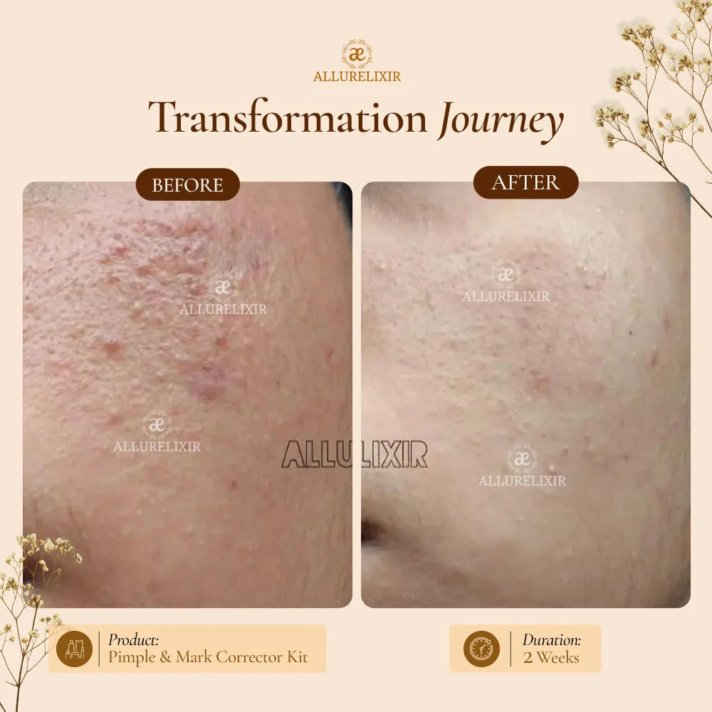 Mega Pimple & Mark Corrector kit (Tulsnah Pack + Varnyah Pack + Ardhrah Gel + Face cleanser)