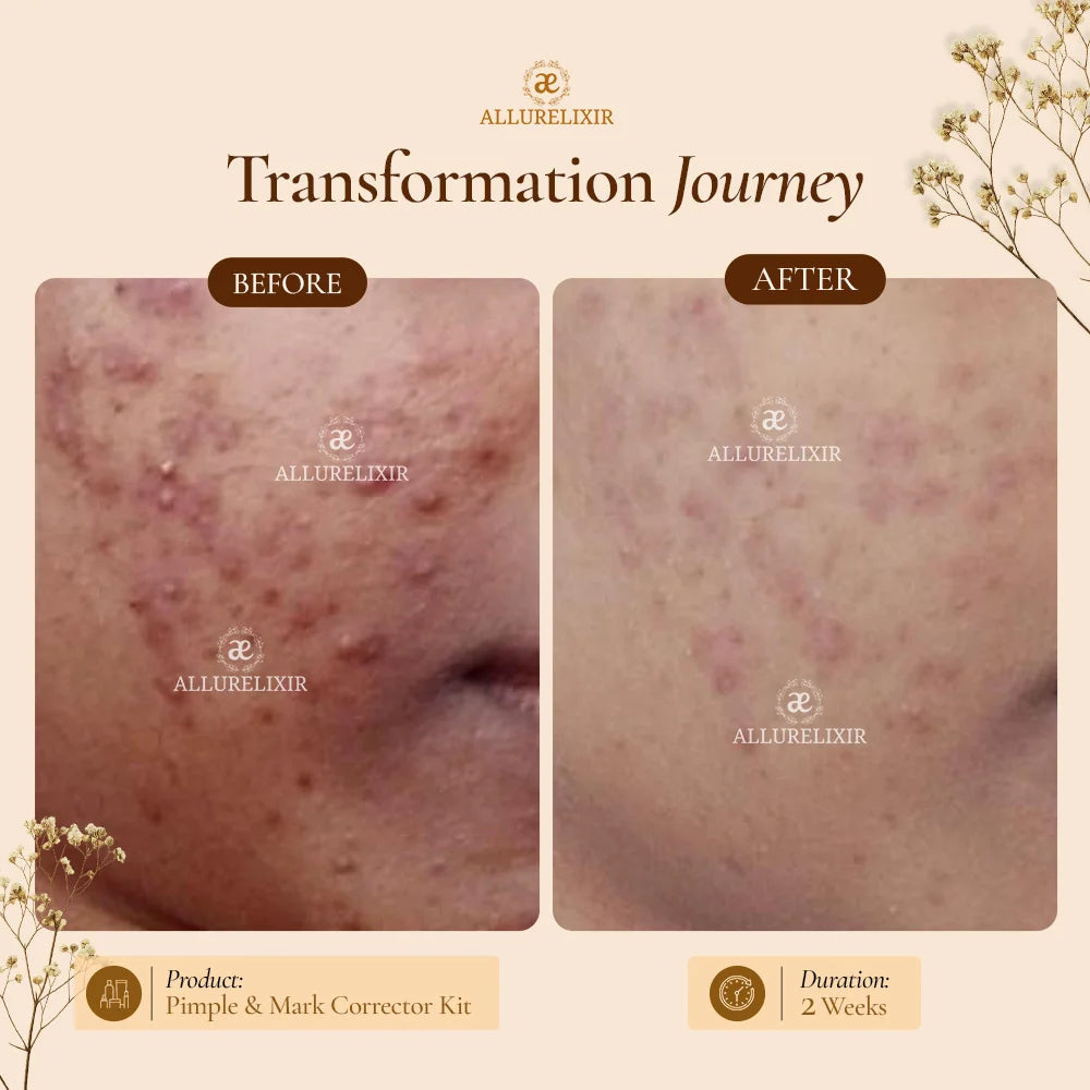 Pimple & Marks Corrector Kit (Tulsnah Pack + Varnyah Pack + Ardhrah gel )
