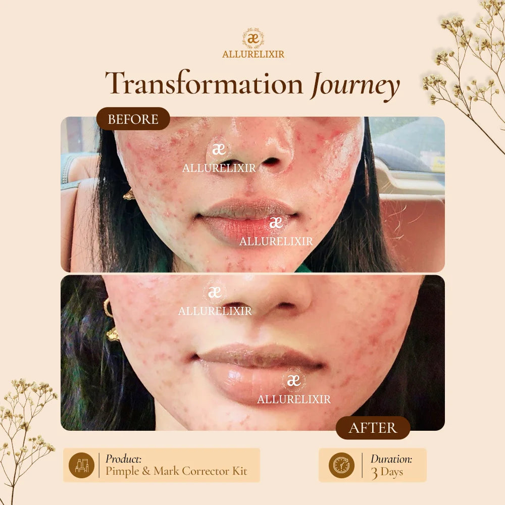 Pimple & Marks Corrector Kit (Tulsnah Pack + Varnyah Pack + Ardhrah gel )