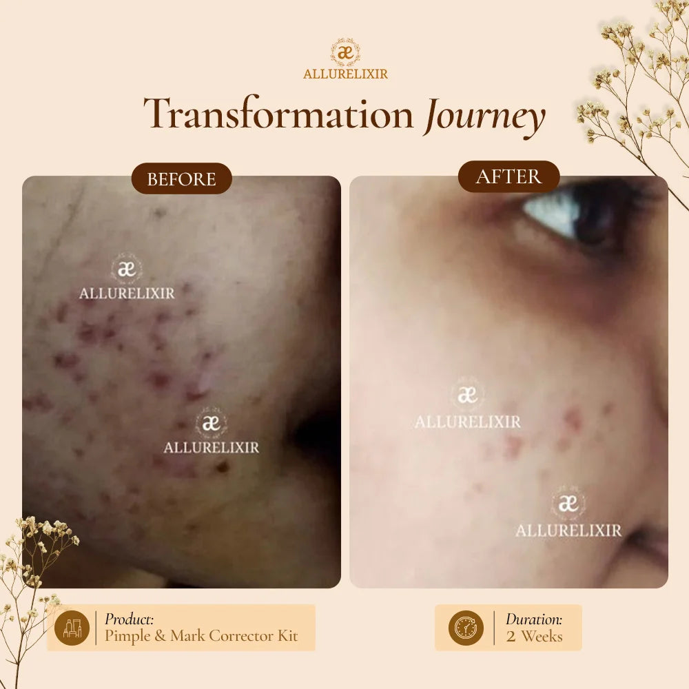 Tulsnah: Acne care Pack
