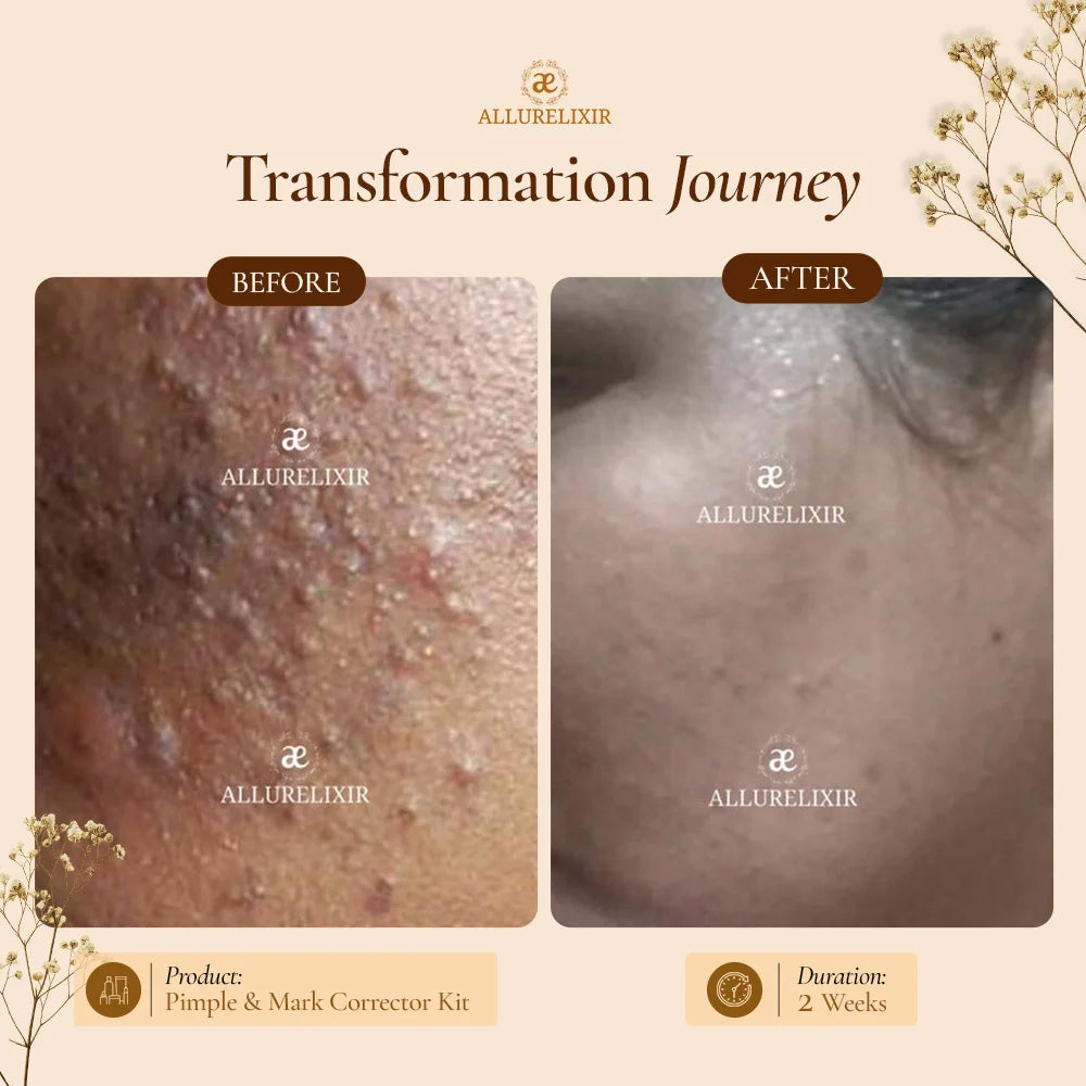 Pimple & Marks Corrector Kit (Tulsnah Pack + Varnyah Pack + Ardhrah gel )