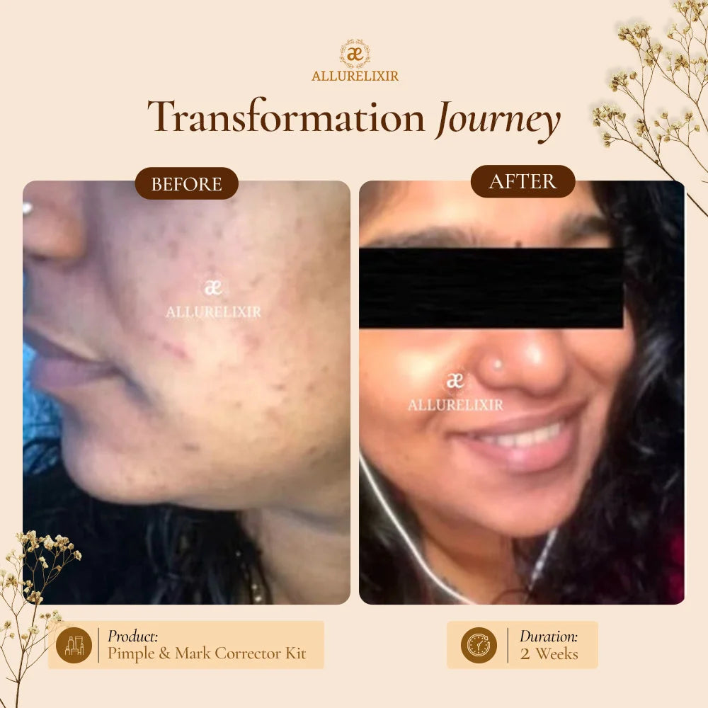 Pimple & Marks Corrector Kit (Tulsnah Pack + Varnyah Pack + Ardhrah gel )