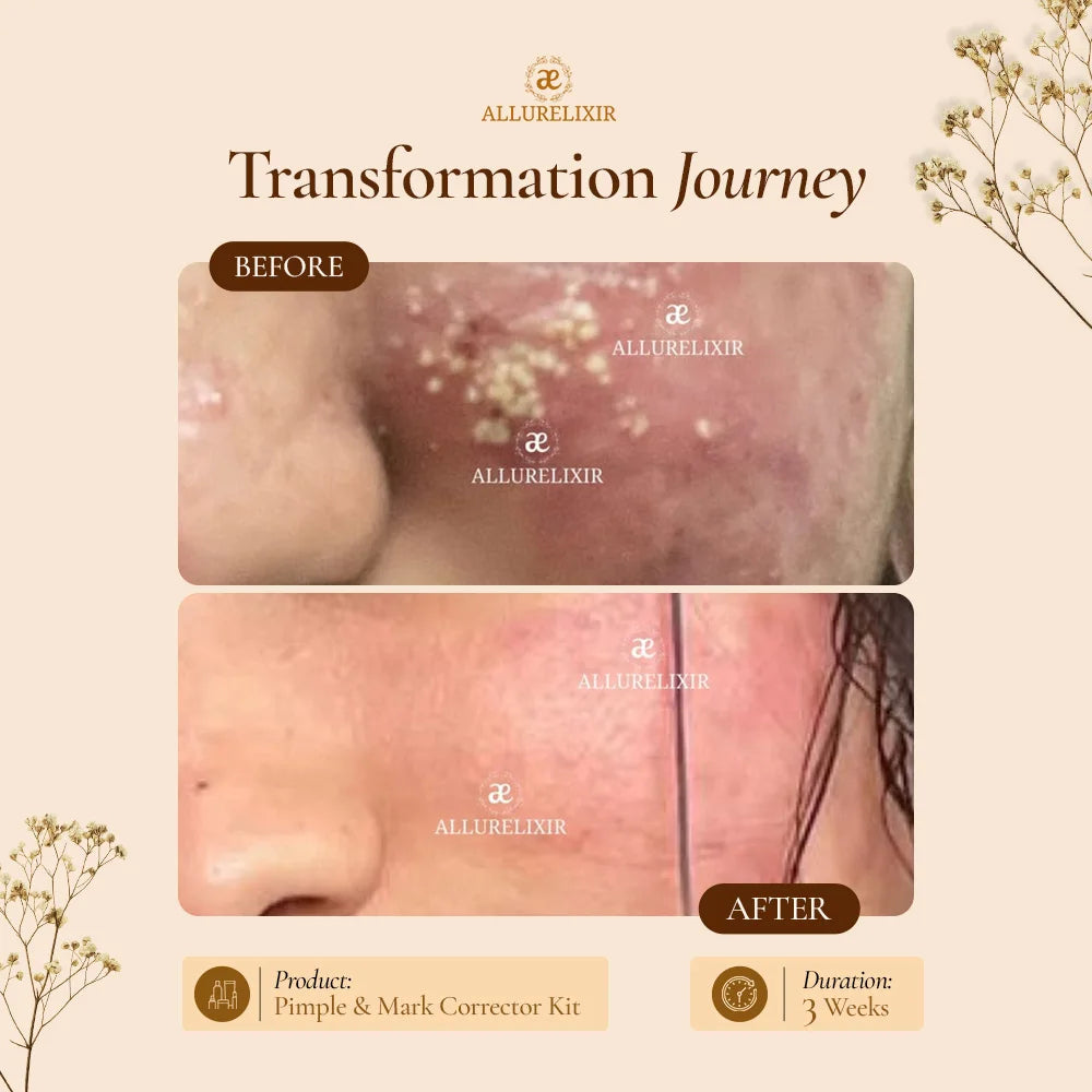 Pimple & Marks Corrector Kit (Tulsnah Pack + Varnyah Pack + Ardhrah gel )