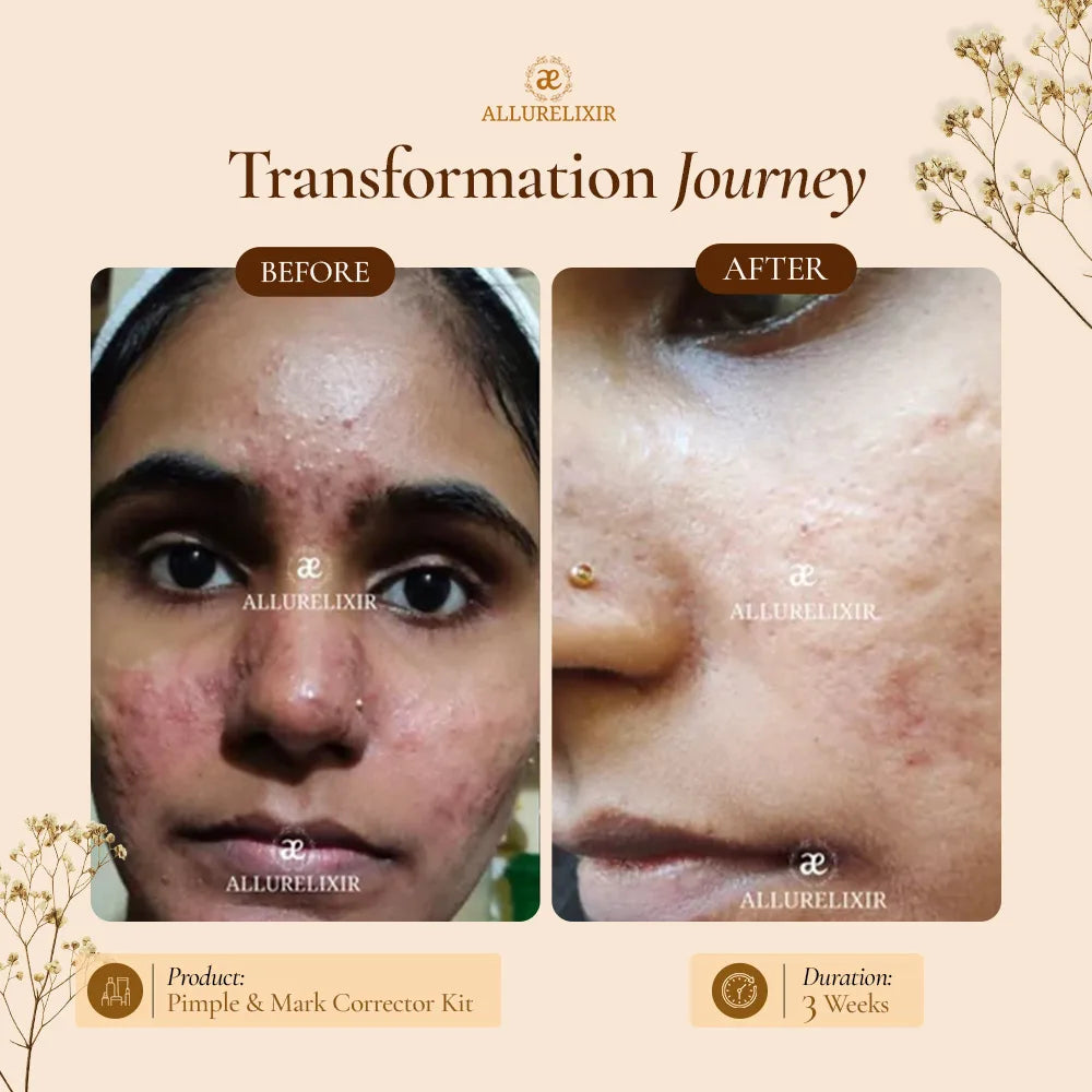 Pimple & Marks Corrector Kit (Tulsnah Pack + Varnyah Pack + Ardhrah gel )