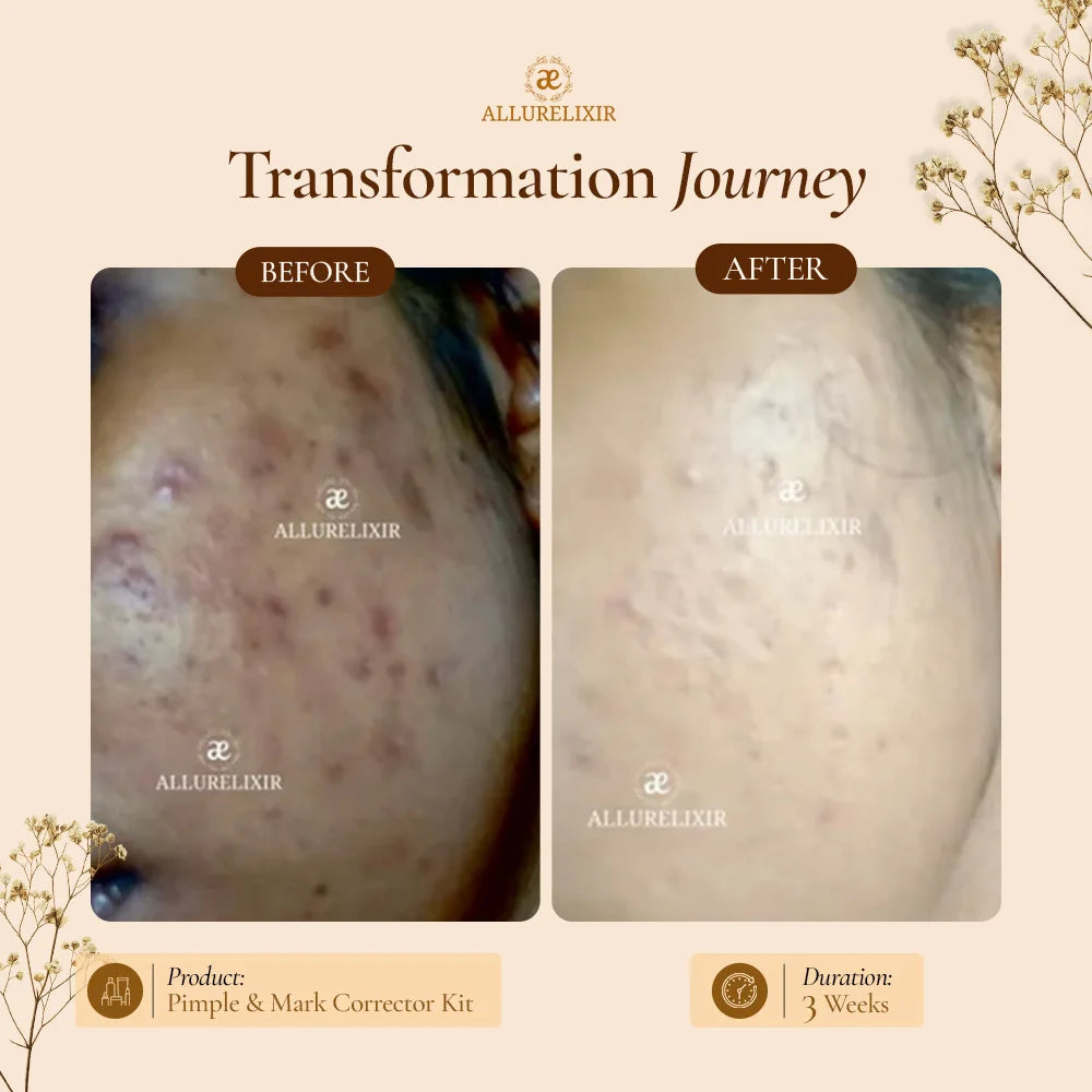 Pimple & Marks Corrector Kit (Tulsnah Pack + Varnyah Pack + Ardhrah gel )