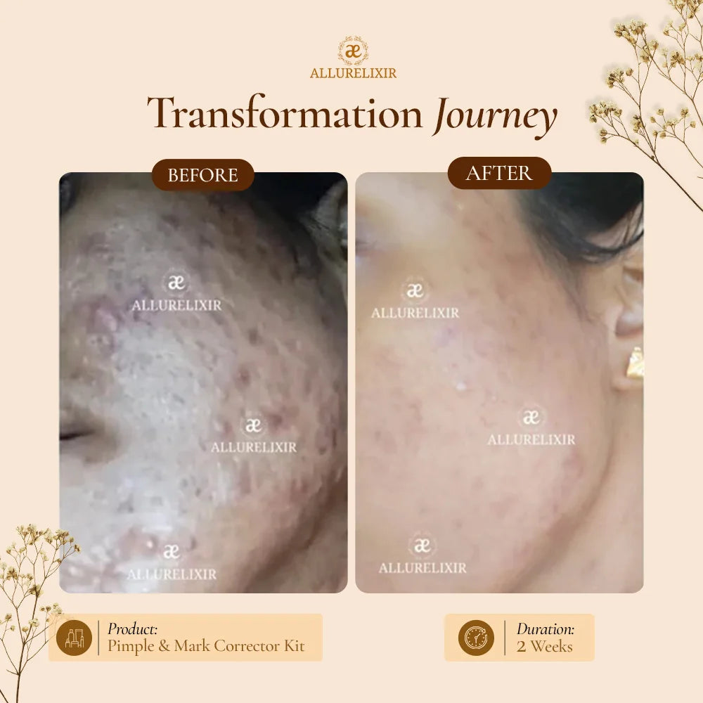 Pimple & Marks Corrector Kit (Tulsnah Pack + Varnyah Pack + Ardhrah gel )