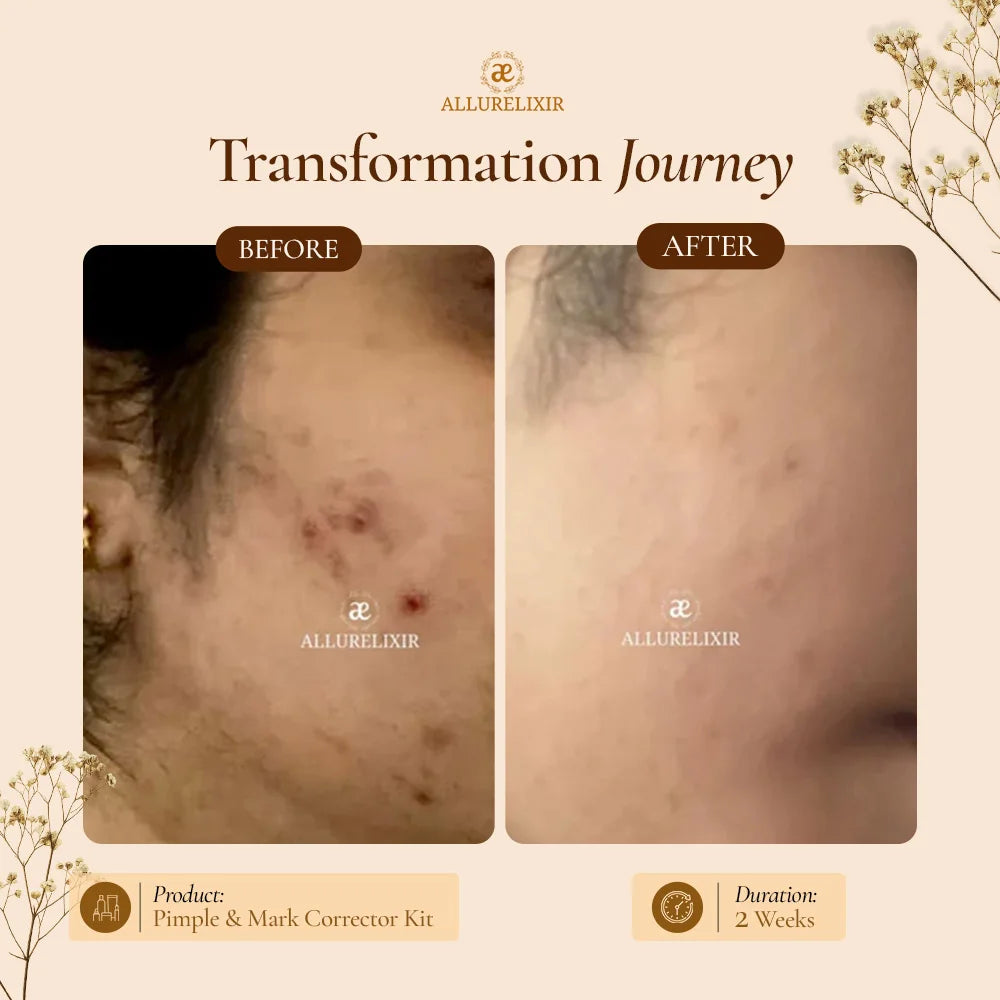 Pimple & Marks Corrector Kit (Tulsnah Pack + Varnyah Pack + Ardhrah gel )