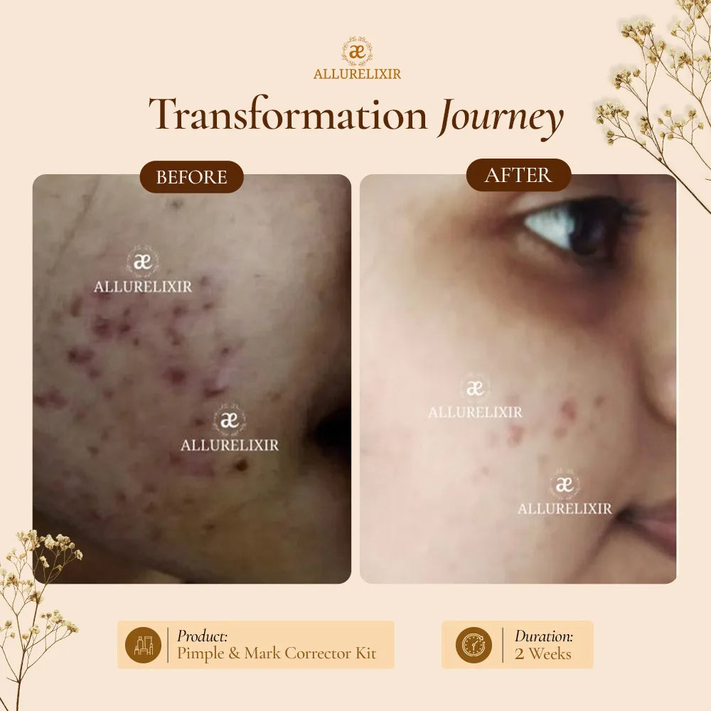 Pimple & Marks Corrector Kit (Tulsnah Pack + Varnyah Pack + Ardhrah gel )